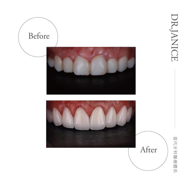水雷射牙齦-前牙美學-陶瓷貼片療程前後比較-任杏嫦醫師-桃園