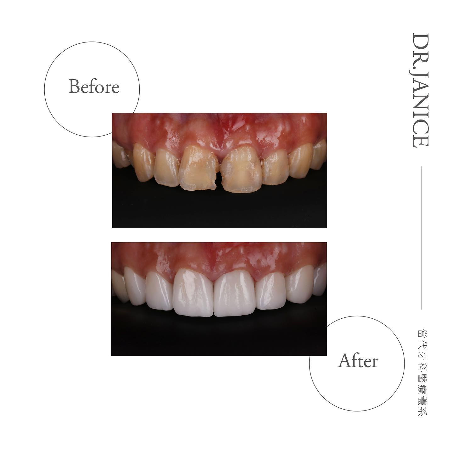 矯正後牙齒黃-牙縫大-陶瓷貼片微矯正-療程前後上排牙齒比較