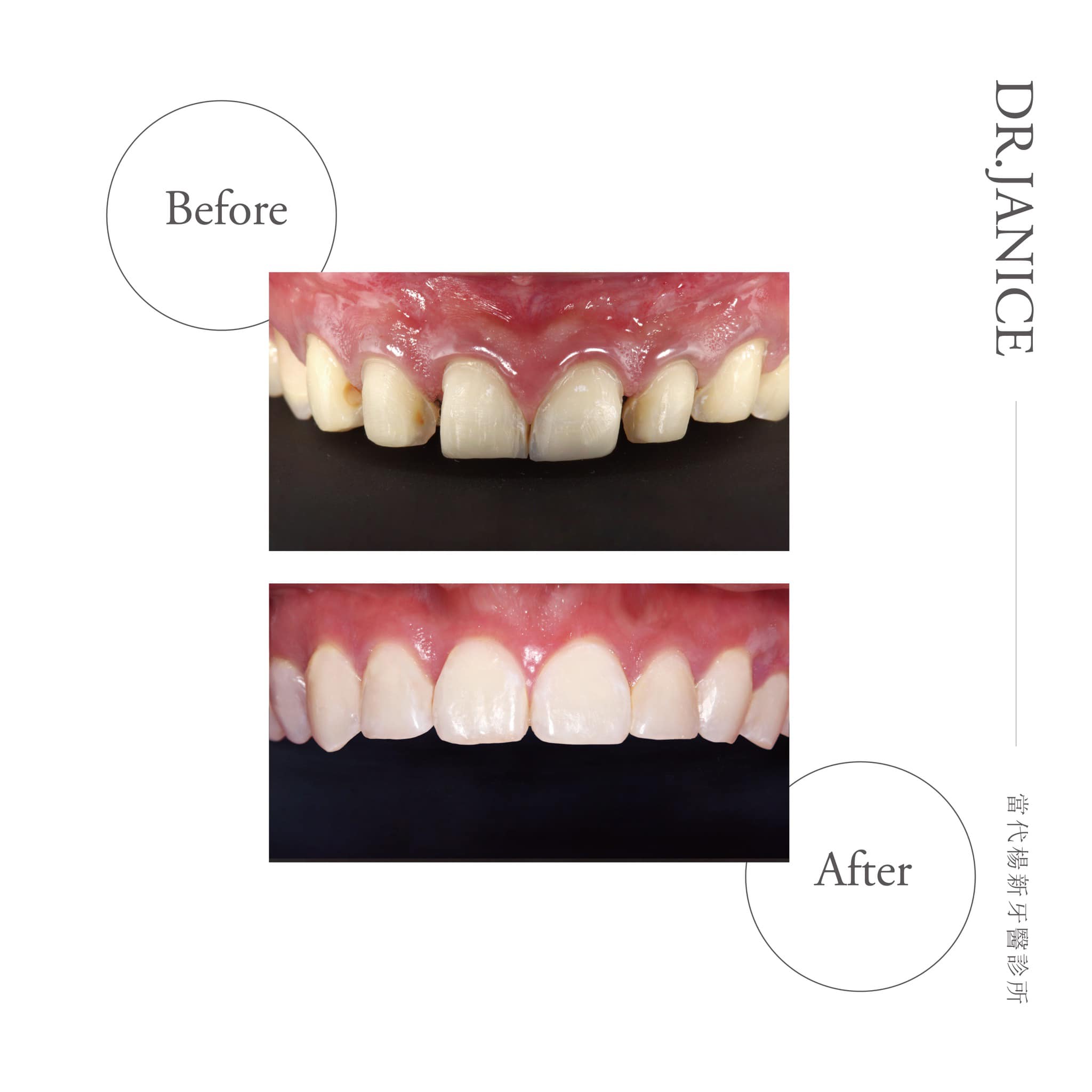 矯正後牙齒黃-牙縫大-陶瓷貼片微矯正-療程前後上排牙齒比較