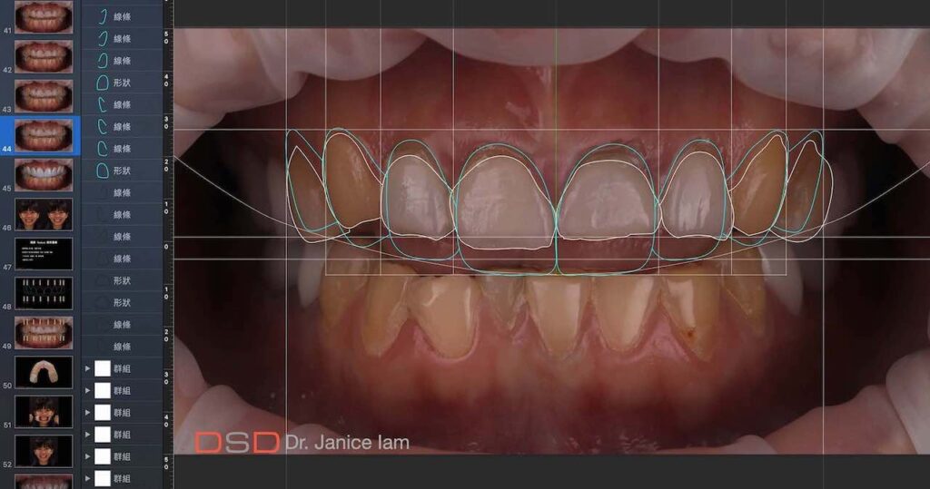 DSD-微笑設計-陶瓷貼片-推薦-桃園-任杏嫦醫師