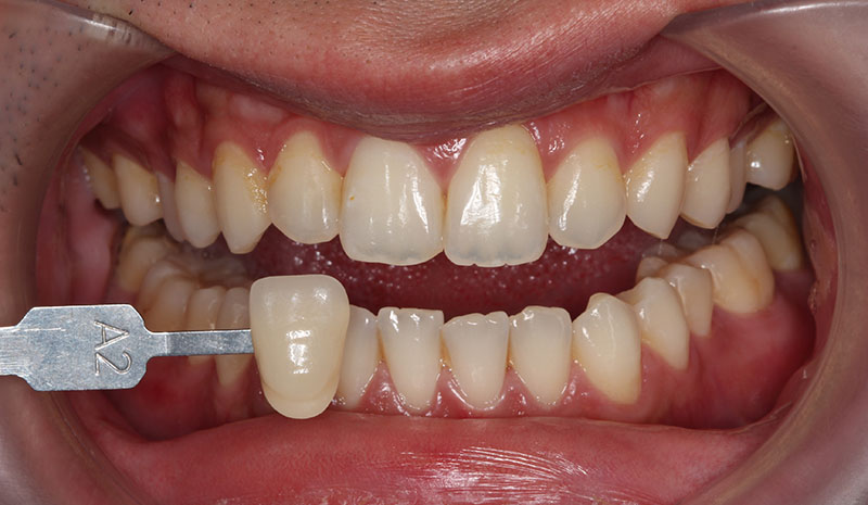 冷光美白療程前，Elvin牙齒顏色約在A2色階