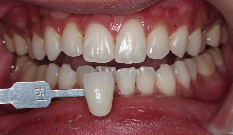 冷光美白療程後大幅改善齒色，將牙齒顏色美白到B1色階