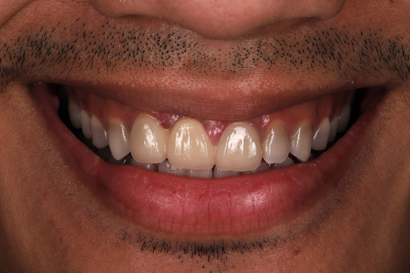 患者Brian四環素牙治療前的笑容外觀