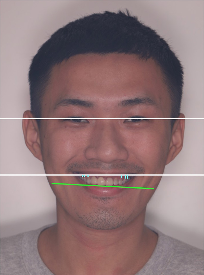 陶瓷貼片的微笑設計評估過程，患者Brian左右邊露出的牙齦高度不一，也有門牙假牙咬合歪斜的狀況