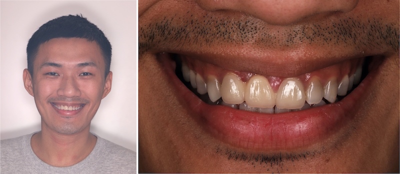患者Brian因四環黴素染色導致牙齒顏色灰暗、靠近牙齦處也呈現黃橘色