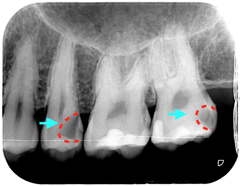 四環素牙治療前，患者Brian的X光片顯示有較深的蛀牙，蛀牙深度已靠近神經