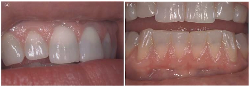 服用四環素衍生物Minocycline引起的牙齒變色，呈現藍灰色調