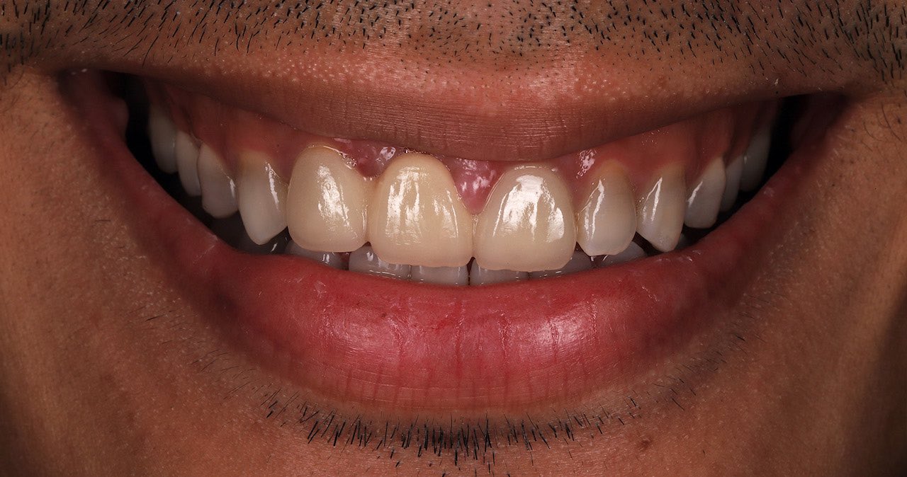 四環黴素牙齒-染色-四環素牙-牙齒美白-推薦-桃園-任杏嫦醫師