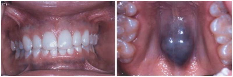長期服用Minocycline造成的「黑色骨頭」，從牙齒正面和顎側都能看到染色痕跡