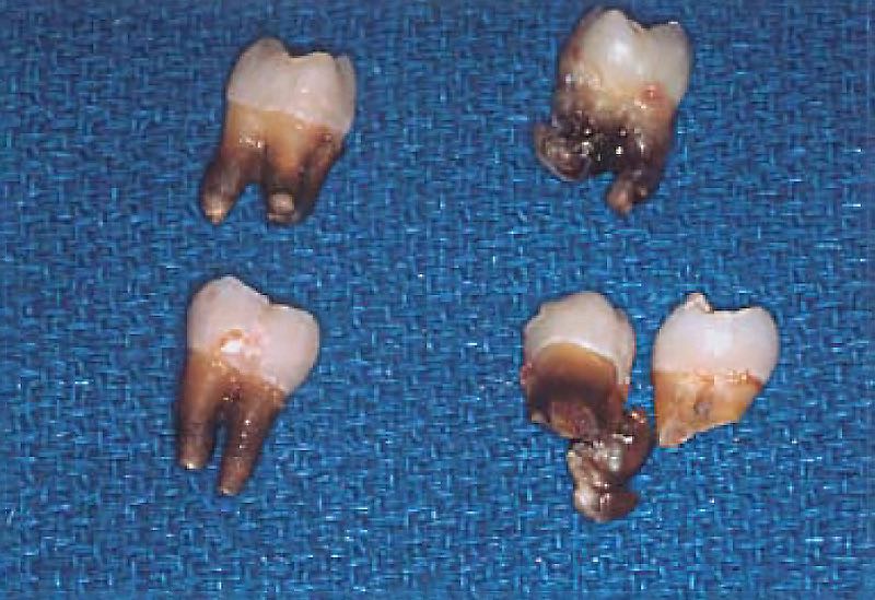 服用四環素衍生物Minocycline使牙根染色變黑