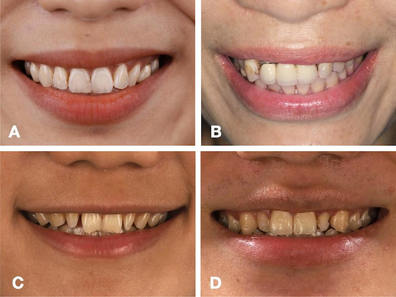 微笑曲線牙齒類型比較-DSD-數位微笑設計-任杏嫦醫師