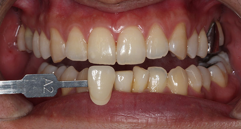 冷光美白療程前牙齒黃，牙齒顏色約在A2色階