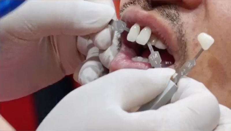陶瓷貼片療程中，任杏嫦醫師為夢多進行牙齒顏色比對