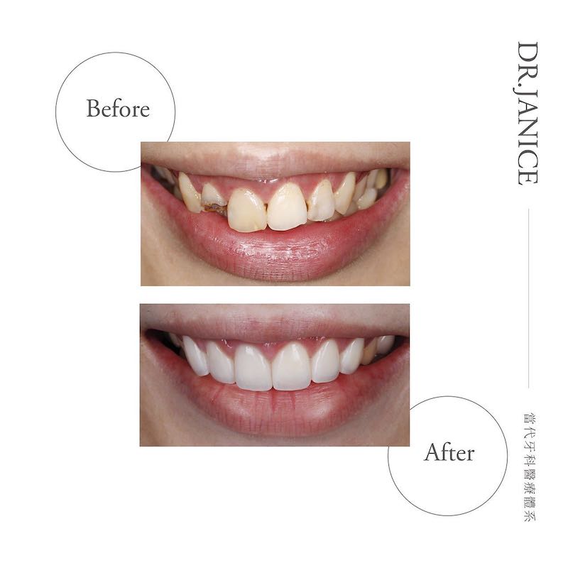 陶瓷貼片-牙齒黃-牙齒缺角-療程前後比較-任杏嫦醫師-桃園-當代牙醫