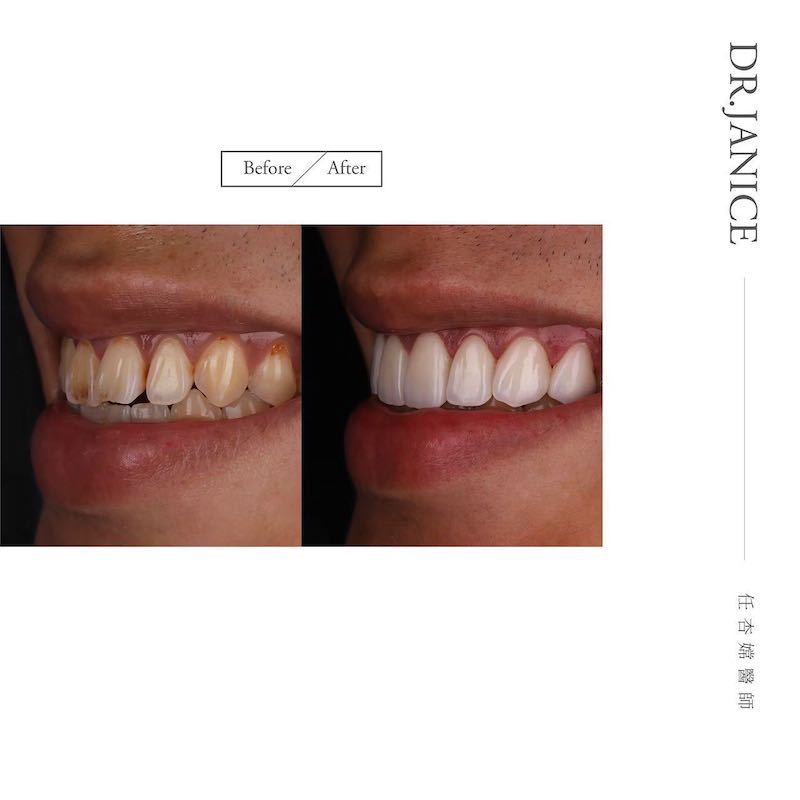 陶瓷貼片療程前後前牙側面對比，解決門牙缺角與牙齒黃，一並改善了門牙旋轉外暴問題