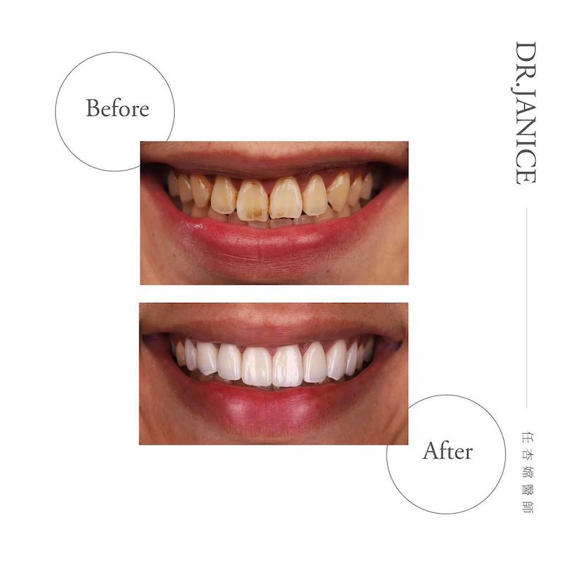 陶瓷貼片療程前後前牙笑容對比，改善門牙缺角，一次美白牙齒並重塑微笑曲線