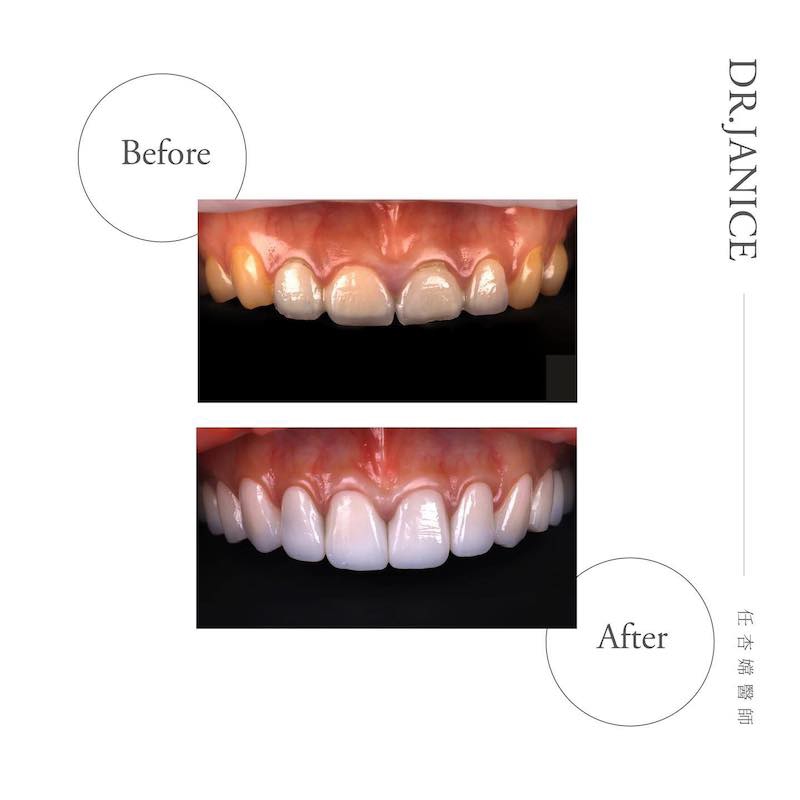 大胃王路路在全瓷冠療程前後的上排牙齒對比，一併改善了牙齒長度、形狀和顏色
