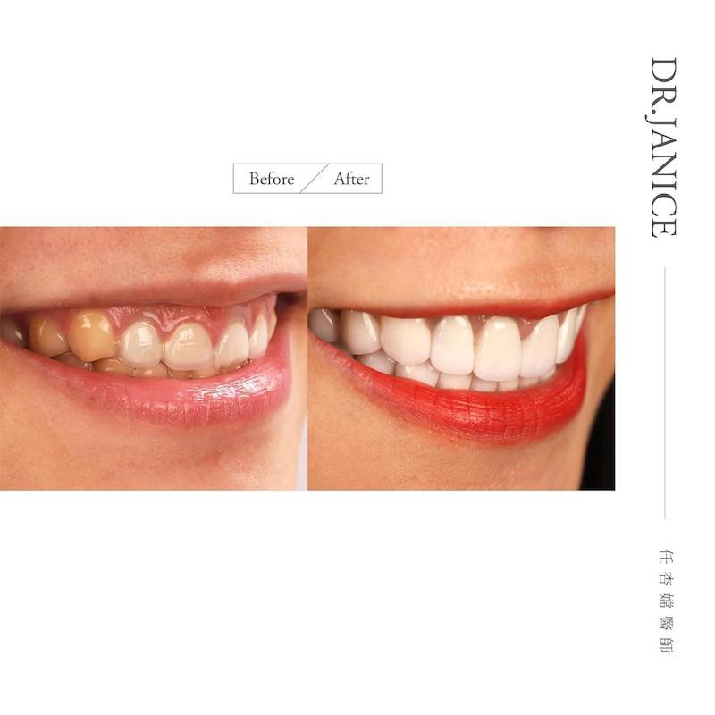 大胃王路路在全瓷冠療程前後的微笑曲線牙齒對比，大幅改善牙齒形狀及顏色
