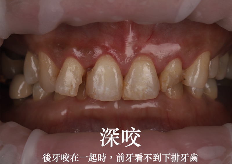 深咬是後牙咬在一起時，前牙看不到下排牙齒，有這類咬合問題做陶瓷貼片前要先進行矯正解決排列問題