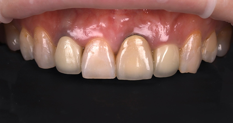 馬來西亞許小姐在陶瓷貼片治療前的上排前牙近照，有牙齒黃、牙齦高低不一、假牙出現金屬黑邊等問題