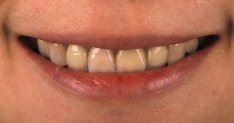馬來西亞許小姐在陶瓷貼片治療前的正面微笑曲線，可見假牙色差、牙齒顏色偏灰黃
