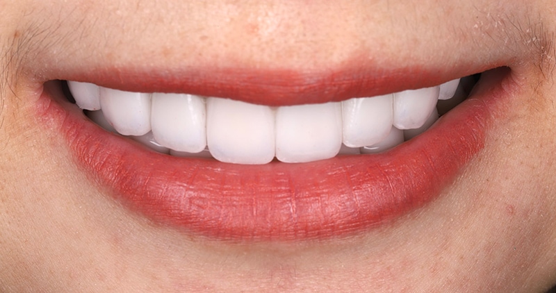 馬來西亞許小姐在陶瓷貼片治療後的微笑曲線，牙齒潔白整齊對稱