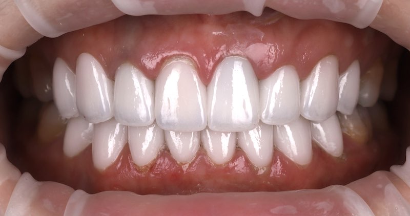 馬來西亞許小姐在陶瓷貼片治療後的牙齒近照，完成上下排牙齒美白，微笑曲線更整齊漂亮