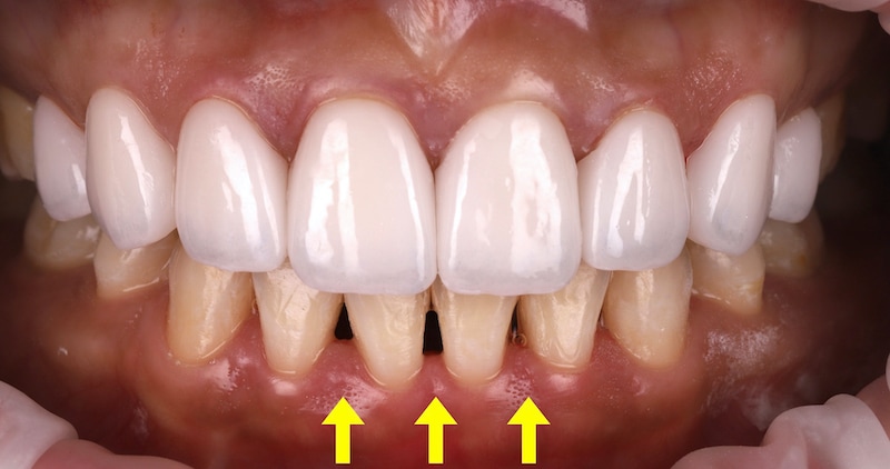 完成上排陶瓷貼片關閉牙縫黑三角，下排牙齒仍有明顯牙縫，且與上排牙齒有色差