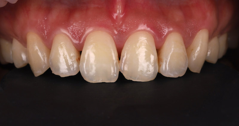 透過水雷射微創牙齦手術重塑上排牙齦形狀，術後牙齦狀況恢復良好