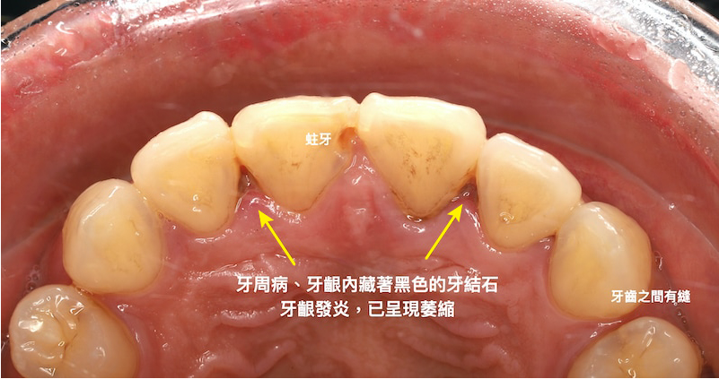 治療前患者上排牙齒有嚴重牙周病、牙齦發炎萎縮，牙齒間縫隙等問題