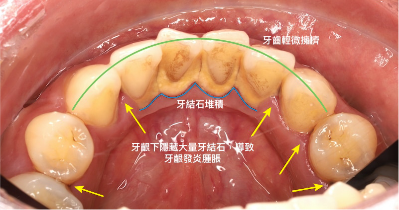 治療前患者的下排牙齒輕微擁擠排列不齊，且牙齒和牙齦下皆有牙結石堆積，導致牙齦發炎腫脹