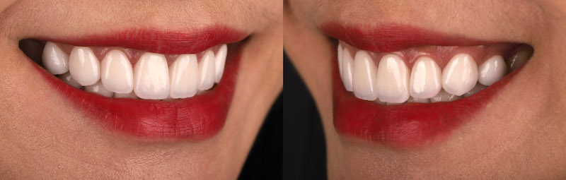 陶瓷貼片療程後的側面笑容近照，微笑曲線牙齒白皙又整齊