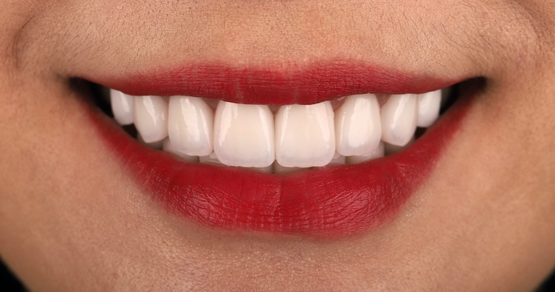 陶瓷貼片療程後的正面笑容近照，微笑曲線牙齒白皙又整齊