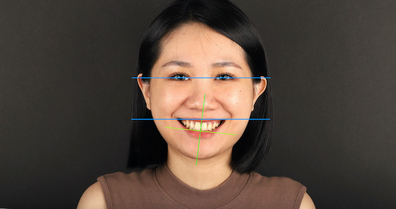 治療前患者臉部外觀：笑起來時門牙歪斜、咬合平面左右兩邊高度不一