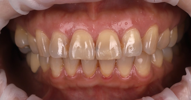 日本患者在陶瓷貼片治療前，牙齒因四環黴素染色呈現灰黃色，伴隨補牙變色、蛀牙等問題