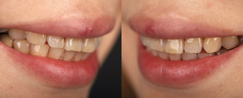 四環素牙治療前，日本患者的牙齒角度向外傾斜呈現暴牙