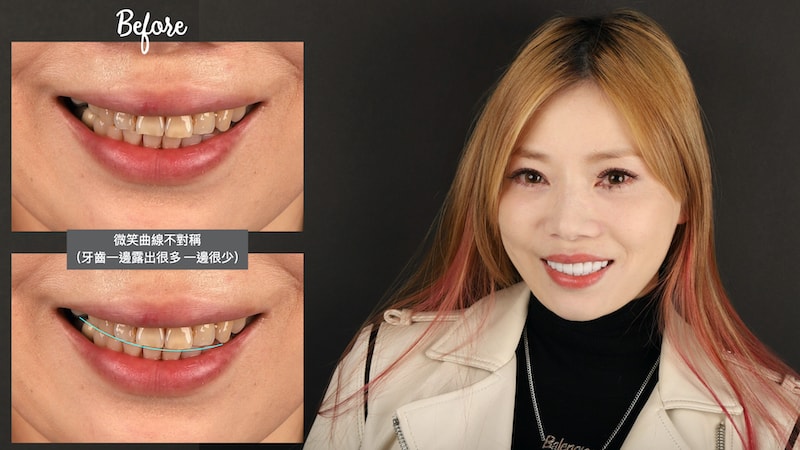 日本患者在台灣完成陶瓷貼片療程，改善四環素牙、微笑曲線不對稱等問題