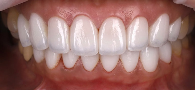 陶瓷貼片搭配美學微笑設計治療四環素牙，塑造整齊潔白的微笑曲線牙齒
