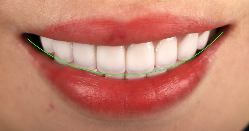 陶瓷貼片治療後的微笑曲線牙齒外觀，牙齒整齊潔白，且微笑曲線與下唇平行
