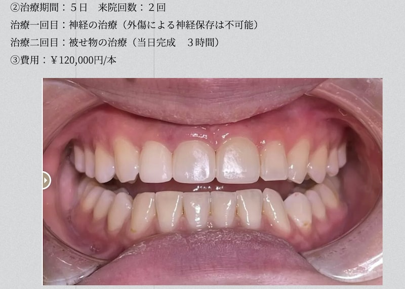 日本牙科抽神經做假牙的價格參考