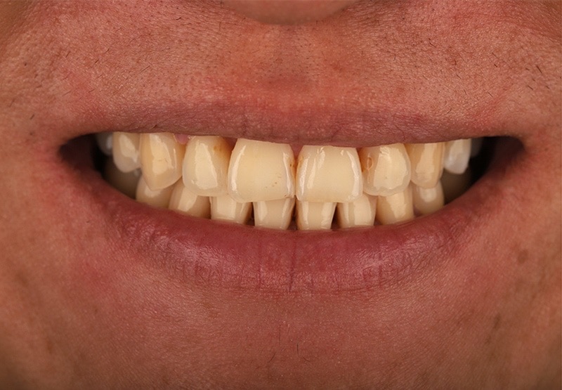 樂天桃猿棒球手張閔勛陶瓷貼片術前的前牙近照，有門牙牙齦萎縮、牙縫黑三角、門牙角度外斜和少量磨損等問題