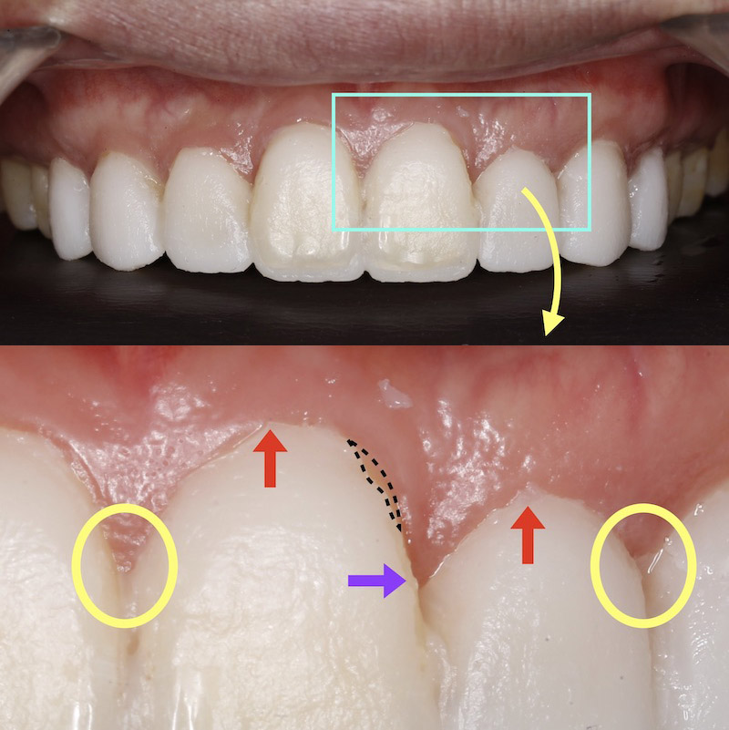 非一日美齒陶瓷貼片療程裝戴的臨時貼片會造成牙齦紅腫發炎流血，增加貼片掉落、牙齦萎縮機率