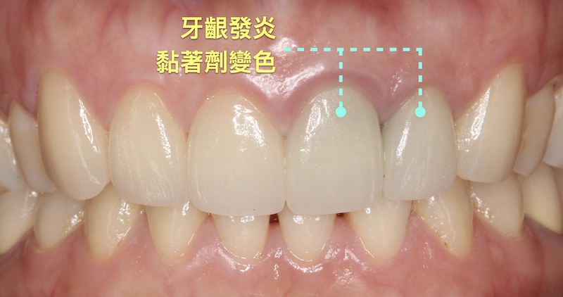 非一日美齒貼片可能會有牙齦流血問題，導致陶瓷貼片變色後遺症