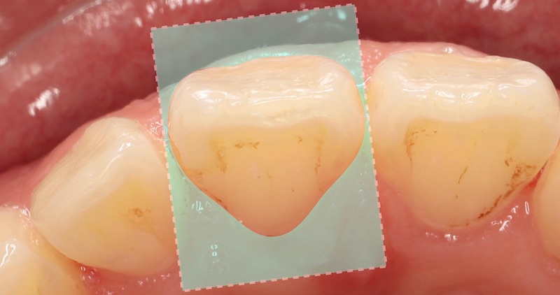 說明貼片與牙齒密合度之局部牙齒示意圖