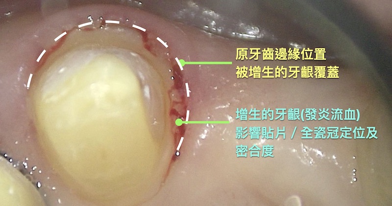 非一日美齒陶瓷貼片可能出現增生牙齦，引發蛀牙、牙周病等後遺症