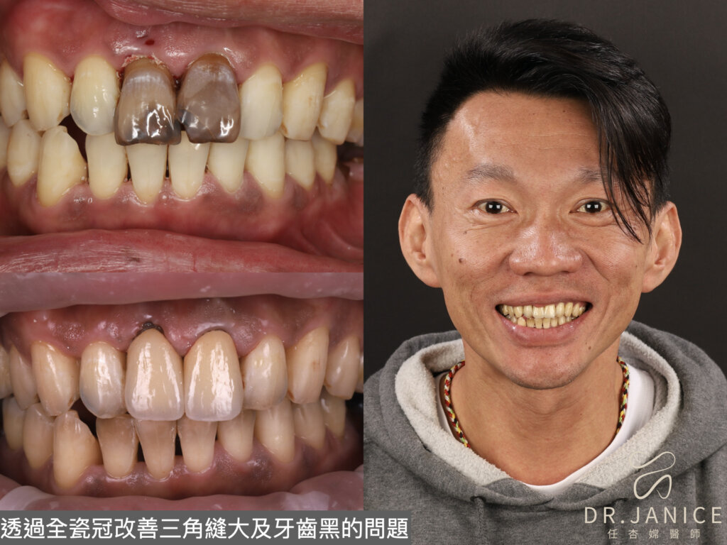 牙縫填補方式2：透過全瓷冠改善黑三角縫問題