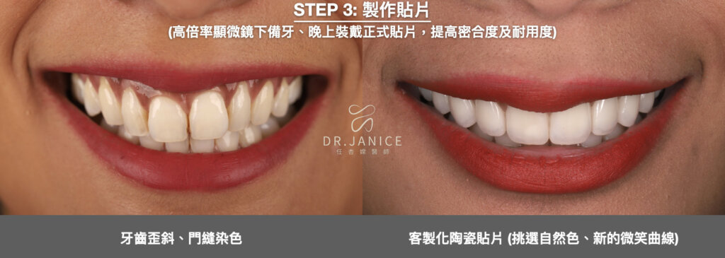 陶瓷貼片顏色案例4：兼具亮白與自然