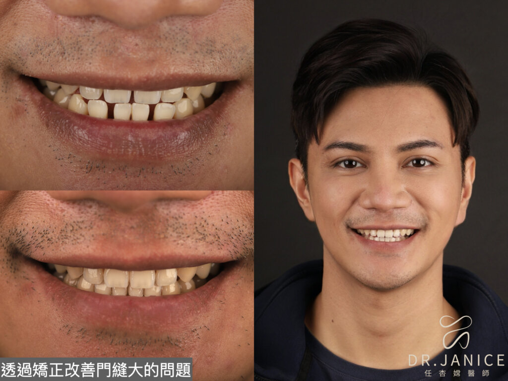 牙縫填補方式3：透過美學矯正改善門牙縫大問題