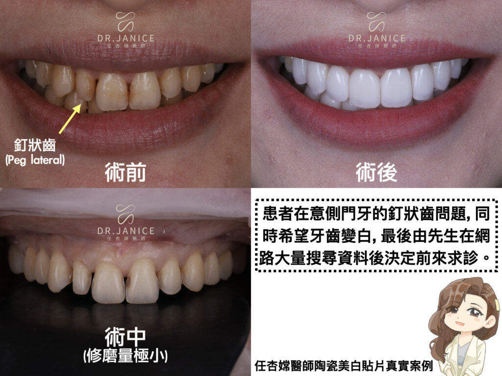 任杏嫦醫師陶瓷貼片案例示意圖