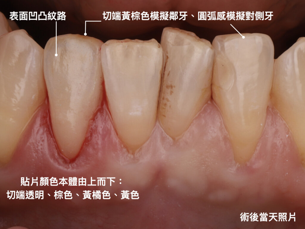 陶瓷貼片顏色案例1：術後當天照片